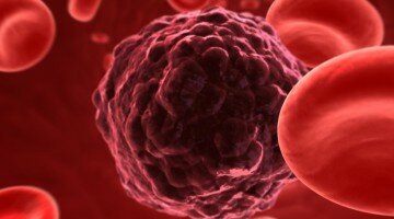 Характеристика онкомаркера СА 15-3, особенности его расшифровки