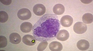 О чем могут сигнализировать повышенные моноциты в крови?
