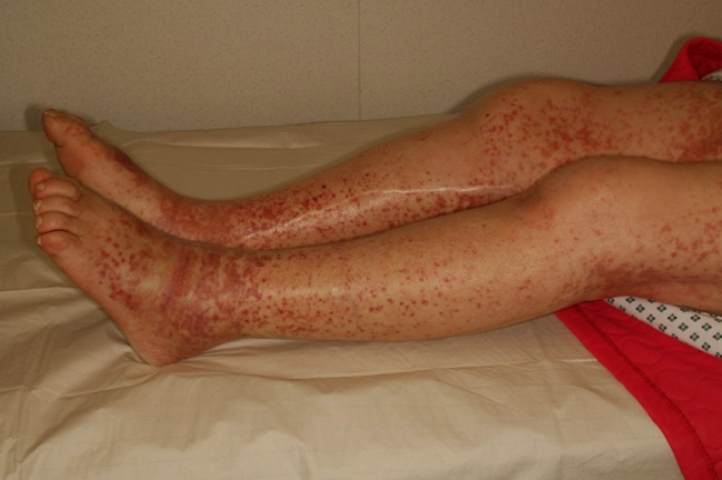 Ноги человека имеющего болезнь Верльгофа