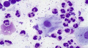 Агранулоцитоз: ответы на все вопросы касательно болезни