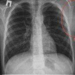 Неходжкинская лимфома