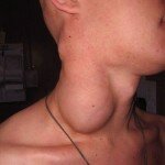 Неходжкинская лимфома