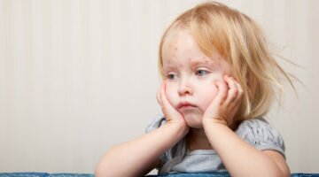 Симптомы, диагностика и лечение кори