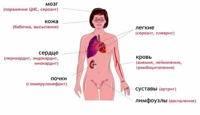Системная красная волчанка (схема)